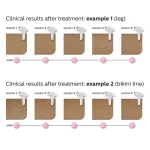 Philips Lumea Series 7000 Αποτριχωτική Μηχανή IPL για Πρόσωπο, Σώμα & Μπικίνι SC1997/00 - Image 14